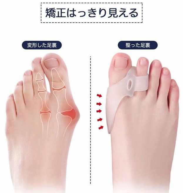 拇指外翻矯正器 腳趾分離器 硅膠材質 舒適佩戴 可穿鞋, 1個, 雙孔大指款2雙