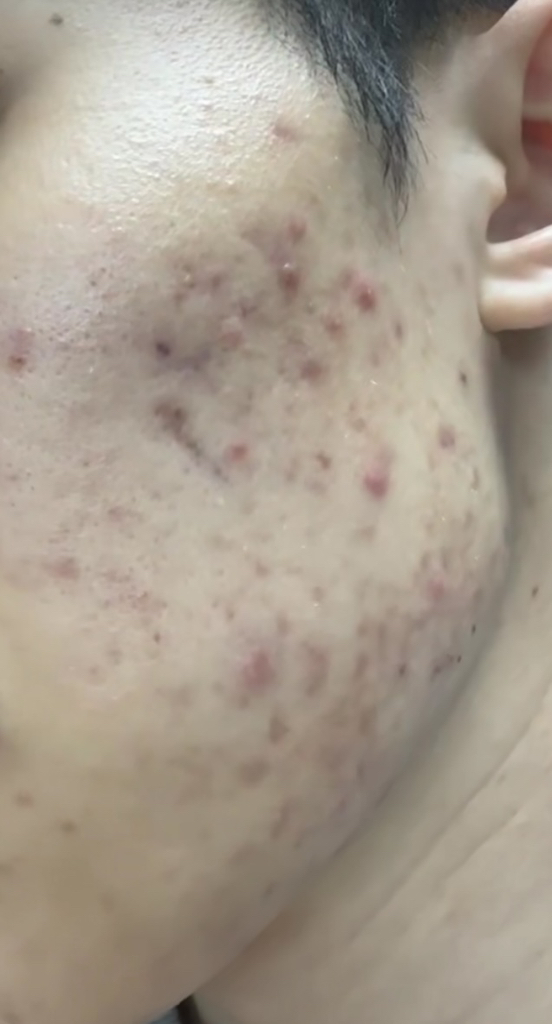 블랑네이처 여드름기능성 클렌징폼 이미지 3