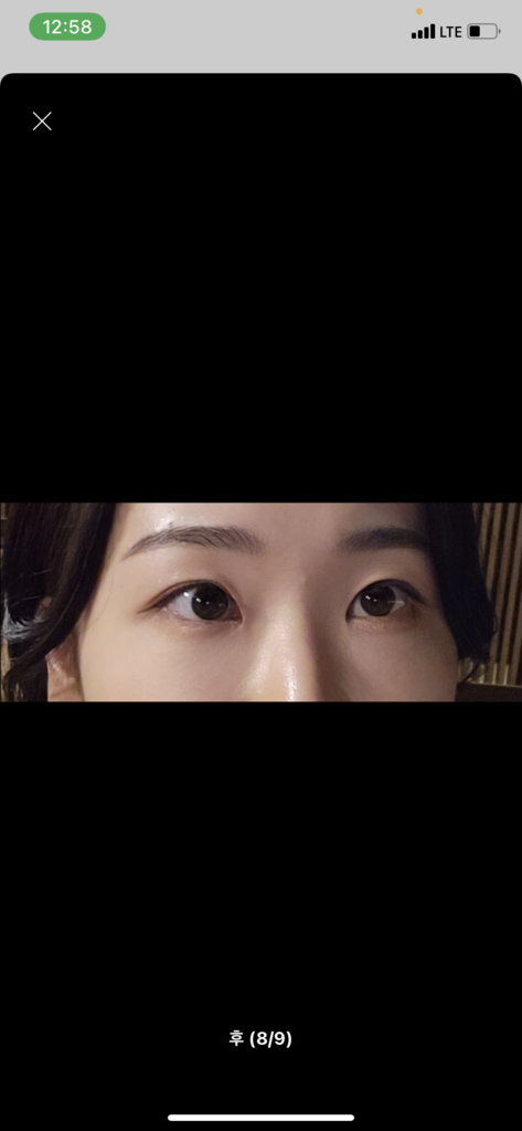 케이시크릿 비타민C 아이패치 (기미패치) 기미관리 눈밑주름 미간주름 솔직 후기 | 피부 타입별 분석 - 상품 이미지 4