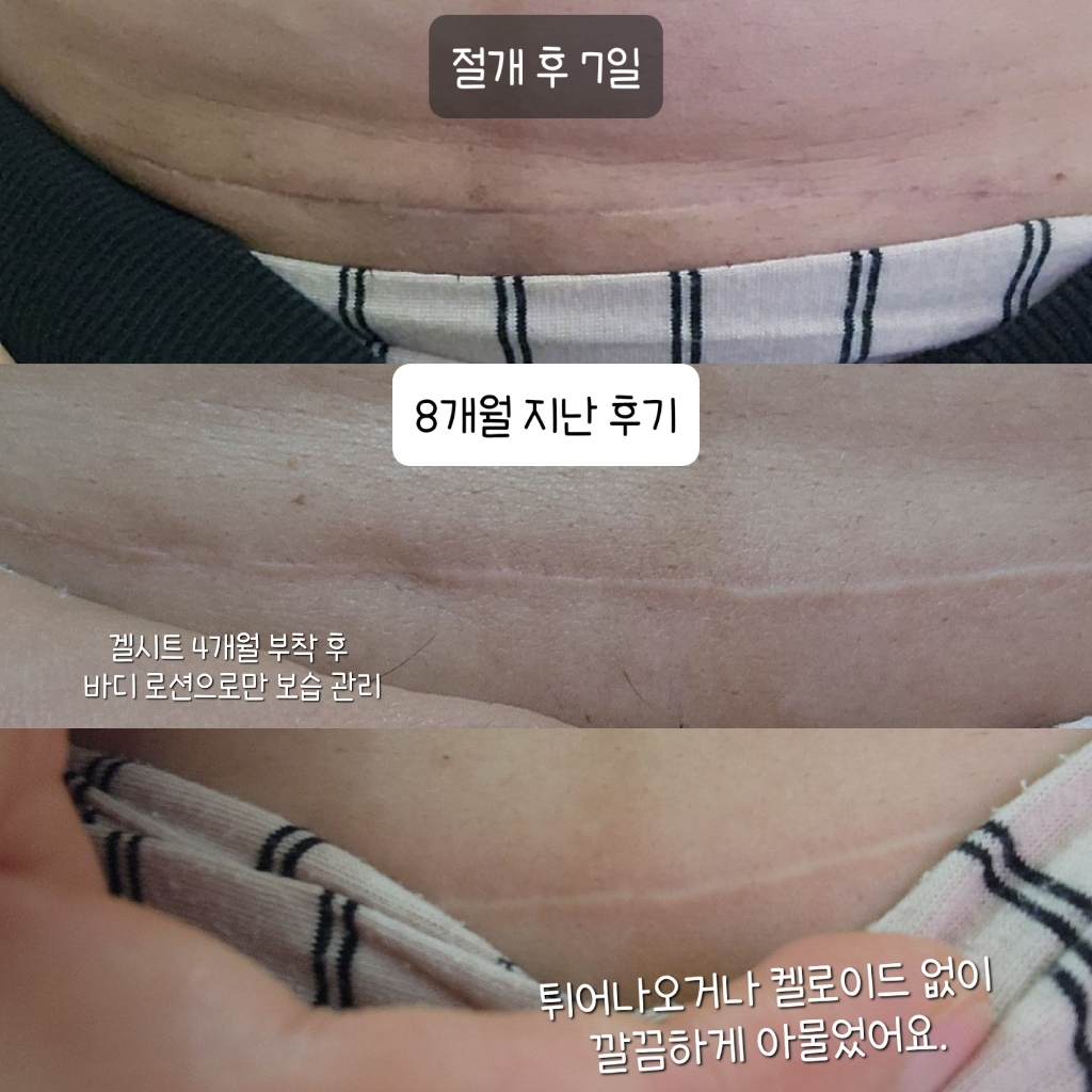 시카케어 실리콘 젤 시트 이미지 2