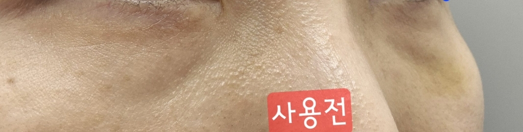 샤르드 아이백 리프트 1100샷 리들 아이패치 솔직 후기 | 실사용자 리뷰 분석 썸네일