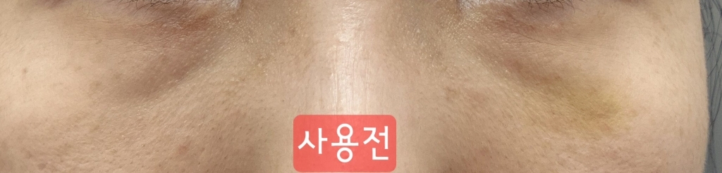 샤르드 아이백 리프트 1100샷 리들 아이패치 아이백 눈가리프팅 솔직 후기 | 피부 타입별 분석 - 상품 이미지 4