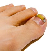M (14 x 4.5 mm) × 1세트