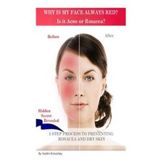 為什麼我的臉總是紅？是痤瘡還是紅斑痤瘡？, 創造空間