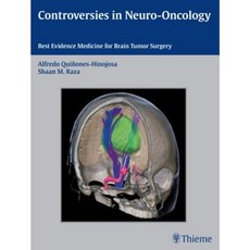Controversies in Neuro-Oncology: Best Evidence Medicine for Brain Tumor Surgery Hardcover, Thieme Medical Publishers