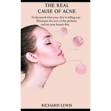 The Real Cause Of Acne: Understand what your skin is telling you. Eliminate the root of the problem ... Paperback, Independently Published