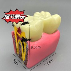 치아 충치 구강모형 우식 발달 교육 실습용 교구 이빨 잇몸 해부, 우식 4021 양면의 6x 비교모델