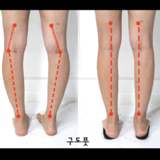 1+1 오다리 깔창 x다리 오다리용 팔자걸음 휜다리 걸음걸이 교정 2켤레 구도풋, 2세트
