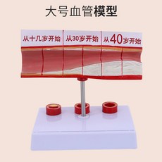 동맥경화 모형 혈관 비교 교구 심혈관 모델 폐쇄 교육용 내과, 대혈관 모형