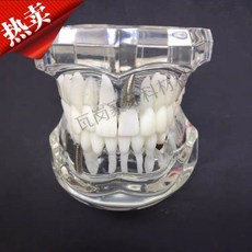 치아 충치 구강모형 우식 발달 교육 실습용 교구 이빨 잇몸 해부, 병리학적 수리 모델 화이트 2001