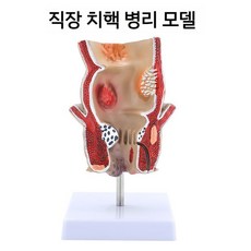대장 모형 해부학 병리 장기기관 교육용 실습 인체모형, 직장