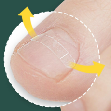 10매+10매 퍼펙토 내성발톱 교정기 스트립 교정팁 의료기기 자가치료 세트, 10개