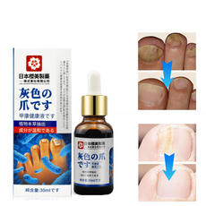 [국내당일출고] 발톱 앰플 발톱 곰팡이 문제성발톱 영양제, 1개, 29ml