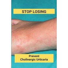 Stop Losing: Prevent Cholinergic Urticaria: Losing Itchy Hair Paperback, Independently Published