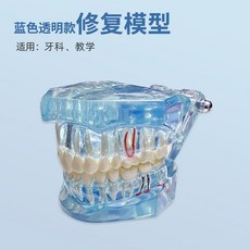 치아모형 치과 탈착식 임플란트 투명 개폐형 교육용 전시, 블루 크리스탈