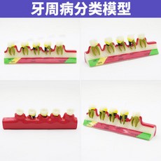 구강 치아 모형 치과 병원 시연 설명 교육용 모형 소품, 1개, 치주 분류 모델