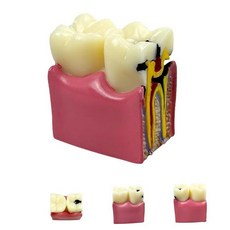 SENLIN DENTAL 탈착식 타이포돈트 치아 모델 28개 연습 및 공부를 위한 부드러운 껌이 있는 치과 교육 모델 스크루 드라이버 랜덤 6개의 포함 (탈착식 28개), 6X Dental Caries Teeth Model