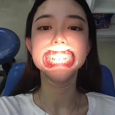 입 벌리는 도구 치과 개구기 마우스 성인 세트 10개, C형 중형 밀키화이트 10개입, 1개, 1L
