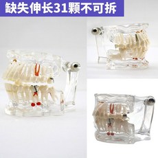 치열 교정 치아모형 치과 구강 모델 덴티폼 금속 교정기 구조, 31개 빠진 치아 모델