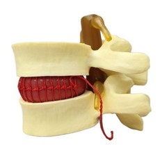 요추 모형 척추 뼈 디스크 추간판 탈출 신경 압박 인체 해부학, 1개, 옐로우