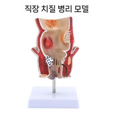 인체 치질 모형 직장 항문외과 병리학 해부학, 직장 병리학, 1개