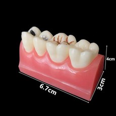 치아 충치 구강모형 우식 발달 교육 실습용 교구 이빨 잇몸 해부, 3회 구덩이 및 열구 밀봉 모델 M10