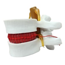 요추 모형 척추 뼈 디스크 추간판 탈출 신경 압박 인체 해부학, 1개, 화이트