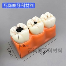 치아 충치 구강모형 우식 발달 교육 실습용 교구 이빨 잇몸 해부, 4x 우식 분해 모델 M1
