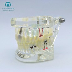 치아모형 충치 모형 구강 진료실 교육용 이빨, A. White Repair 2001, 1개