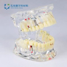 치아 충치 구강모형 우식 발달 교육 실습용 교구 이빨 잇몸 해부, 근관 병리학 모델 4012