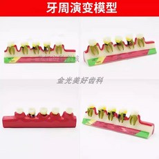 치아 모형 치과 상담 교구 덴티폼, 치주 진화
