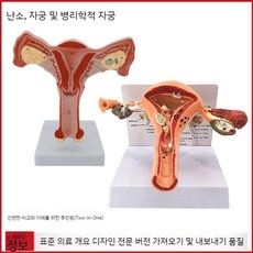 여성 생식 자궁 모델 난소 회음부 병리학적 변화골반 시상, D. 병적 자궁 + 난소 자궁 조합