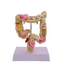 소화계 모형 장기 대장 입체 소화 기관 해부 과학, 직장 병리학