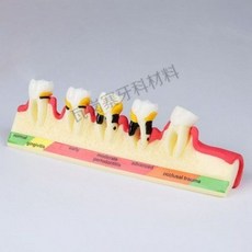 치아 충치 구강모형 우식 발달 교육 실습용 교구 이빨 잇몸 해부, 치주 분류 모델 4010 소프트 잇몸
