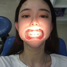 구강 개구기 입 벌림 도구 확장 고정형 치과용 유백색 C형 중형 밀키화이트 10개입, C형 소형 밀키화이트 10개입