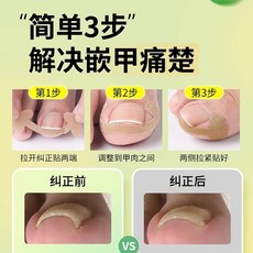 甲溝炎專用矯正貼 解決嵌甲痛楚, 1個, 解決嵌甲*無痛矯正,趾甲不在扎【40貼】*透氣乾爽