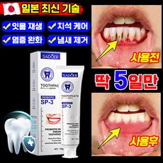 [효과 보장]잇몸 재생 치약 잇몸치약 약국 전용 잇치 치약 치주염 잇몸붓기 이빨 염증 케어 개선 예방 통증 완화 냄새 얼룩 제거 포장 증정, 1개, 100g