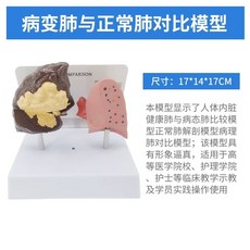 금연 교육 금연캠페인 간접흡연 위험성 폐 흡연, D. 정상 폐와 병적인 폐의 비교