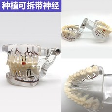 치아 모형 치과 상담 교구 덴티폼, 탈착식 신경 모델