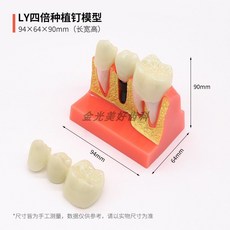 치아 모형 치과 상담 교구 덴티폼, 임플란트