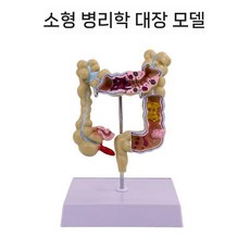 인체 치질 모형 직장 항문외과 병리학 해부학, 대장 병리학(소), 1개