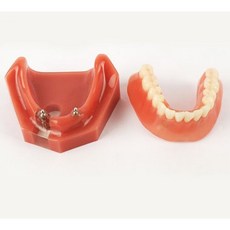 AM010 하악 임플란트 & 오버덴쳐/ 임플란트 치아 모형 하악 임플란트 틀니 환자 교육 설명 치과 병원 장식 장식품