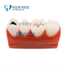 치아모형 치아관리 치과 구강 양치교육 인체 교구 교육 이모형 성인 병리, 3단 피트 및 균열 폐쇄 모델 M10