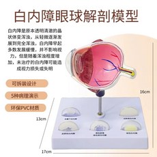 안과 눈 구조 확대 학교 교육용 망막, D. 백내장 안구 모델
