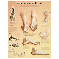 3B Scientific VR3185UU 광택지 Malposiciones De Los Pies 해부학 차트 (발의 변형 해부학 차트 스페인어) 포스터 사이즈 50.8cm 너, 3B Scientific VR3185UU 광택지 Mal