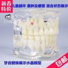 교육용 치아모형 치과 양치질 이빨모형 칫솔질 유치원 치아관리 구강구조 병원, D. 어린이우식치아, 1개