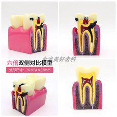 치아 모형 치과 상담 교구 덴티폼, 충치 비교