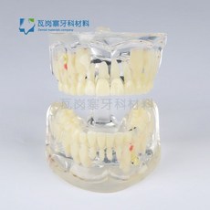 치아 충치 구강모형 우식 발달 교육 실습용 교구 이빨 잇몸 해부, 소아 병리학 모델 4002