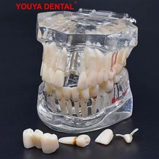 치아모형 칫솔질 구강 교육용 교구 치열 교정 임플란트 모델, 탁부착 치아모델