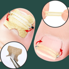 코지덴 와이어 밴드 이중교정 내향성 소형 발톱 셀프케어, 1세트